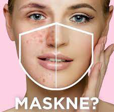 Maskne